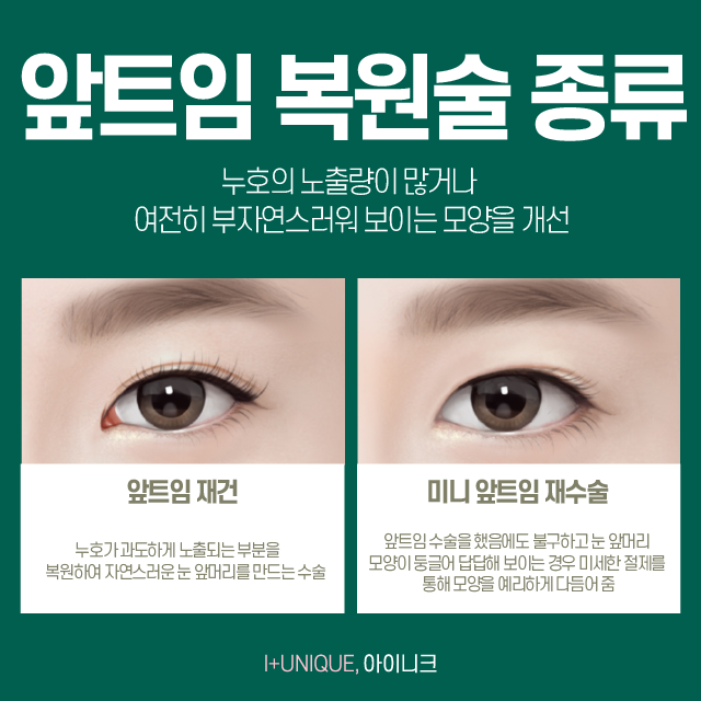 답답해 보이는 눈, 앞트임복원술이 답! 관련 이미지 2