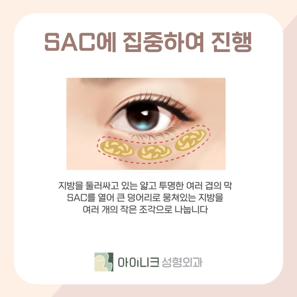 The Procedure Matters as Much as the Price of Under-Eye Fat Removal image 8
