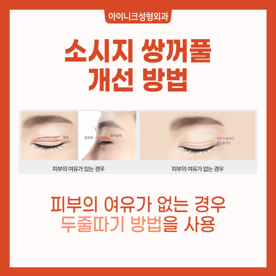 The Best Place for Eyelid Revision Surgery Is Different, Indeed. image 3