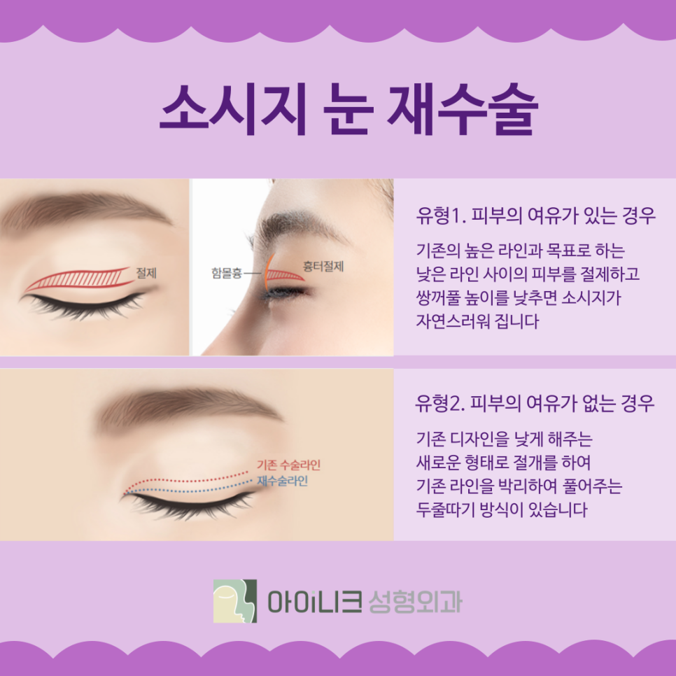 소시지쌍꺼풀 원인과 개선 방법 관련 이미지 4