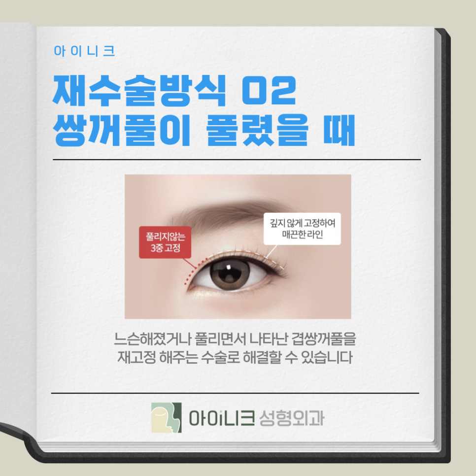 겹쌍꺼풀 여러 개의 주름이 생기는 증상일까요? 관련 이미지 9