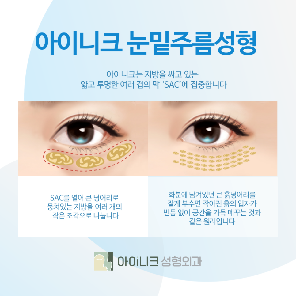 Apgujeong Under-Eye Fat Repositioning: No More Tired Eyes image 4