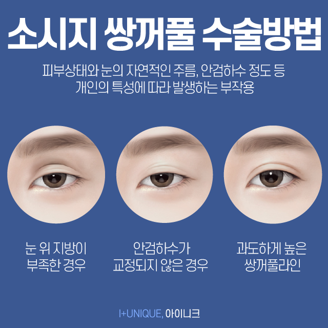 눈재수술성형외과 고를 때 이것만 알아주세요! 관련 이미지 3