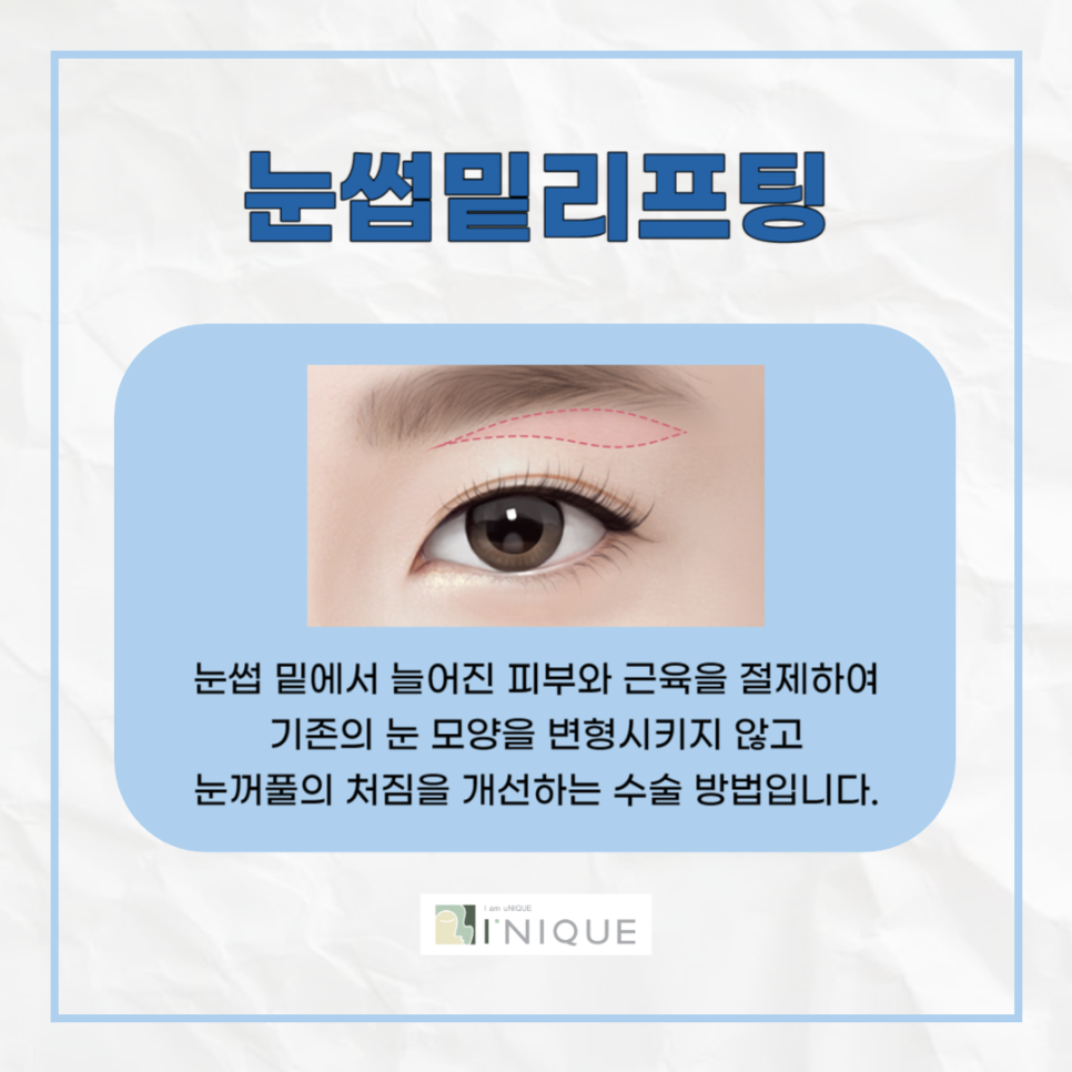 눈꺼풀처짐수술비용, 합리적인 선택을 하려면? 관련 이미지 3