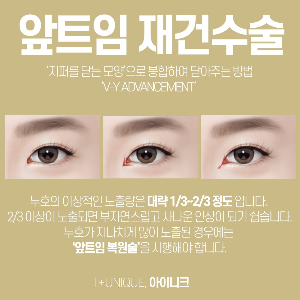 앞트임성형도 자연스럽게 아이니크성형외과에서 관련 이미지 5