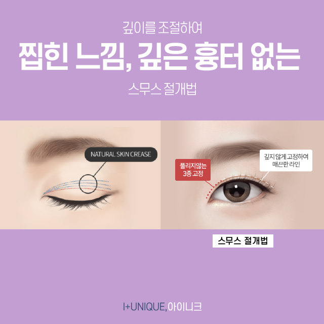 성형의 기본 쌍꺼풀 수술부터 풀린쌍꺼풀, 삼꺼풀 해결 방법까지 모두 알아보기 관련 이미지 2
