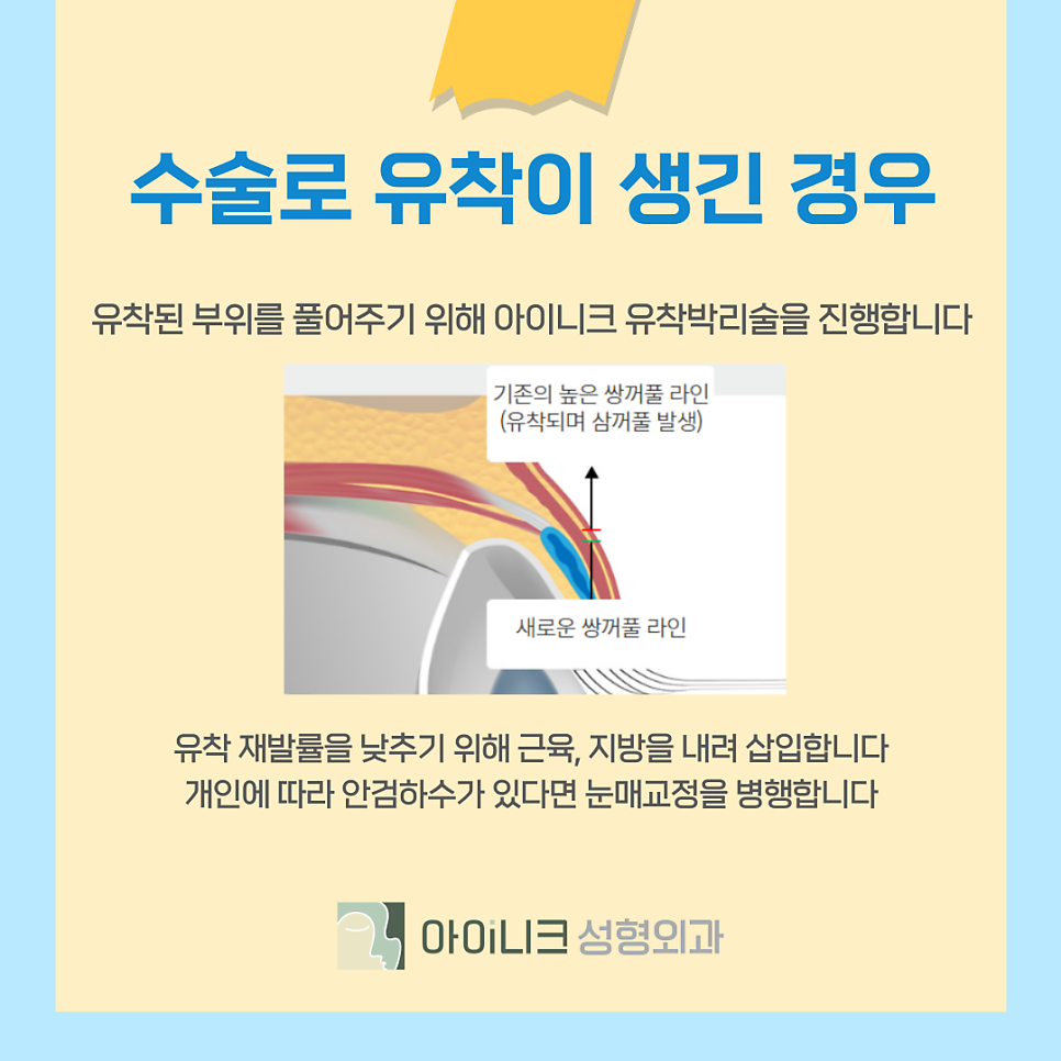 쌍꺼풀 재수술 기간 언제부터 가능한가요? 관련 이미지 14