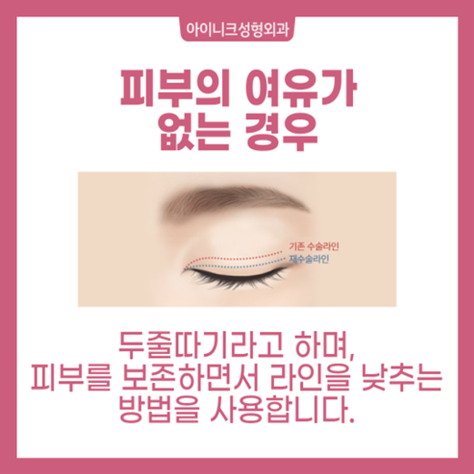 Take a Careful Look at an Apgujeong Eye Revision Surgery Clinic! image 5