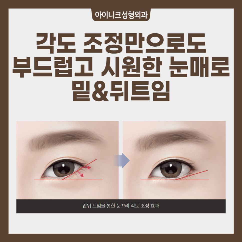 180도 이미지 변신? 압구정트임 수술 관련 이미지 5