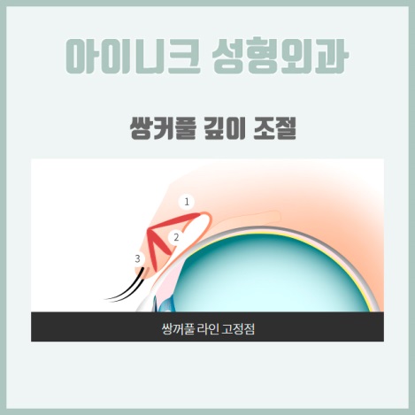 쌍커플재수술비용 원인별 맞춤 솔루션 제공! 관련 이미지 12