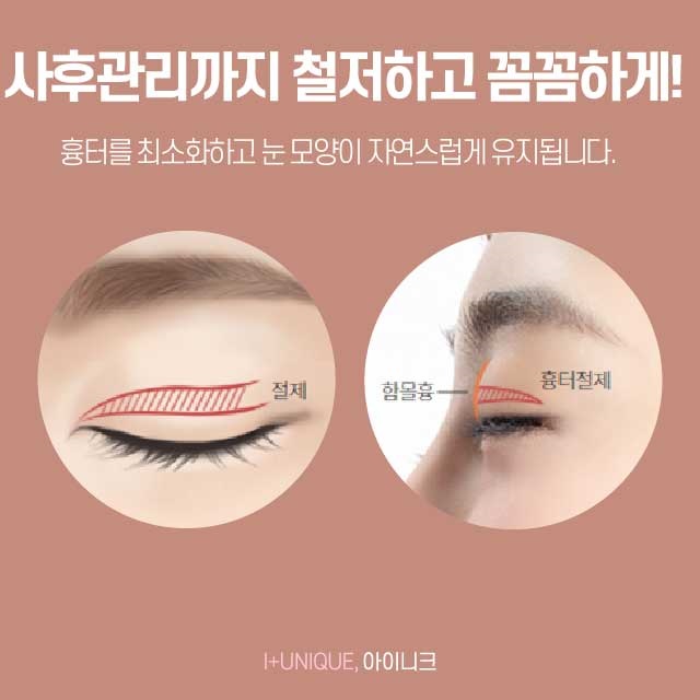 강남쌍꺼풀수술 믿을만 한 곳으로 선택하자! 관련 이미지 5