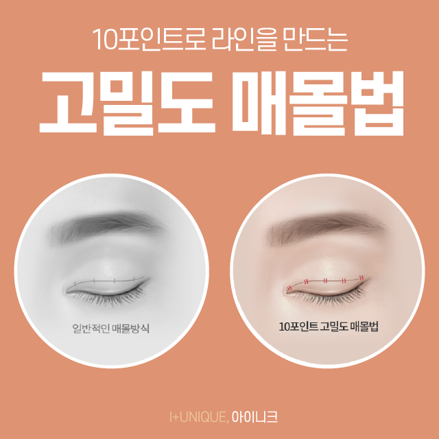 눈두덩이가 두꺼워 고민이라면 지방제거 매몰법! 관련 이미지 3