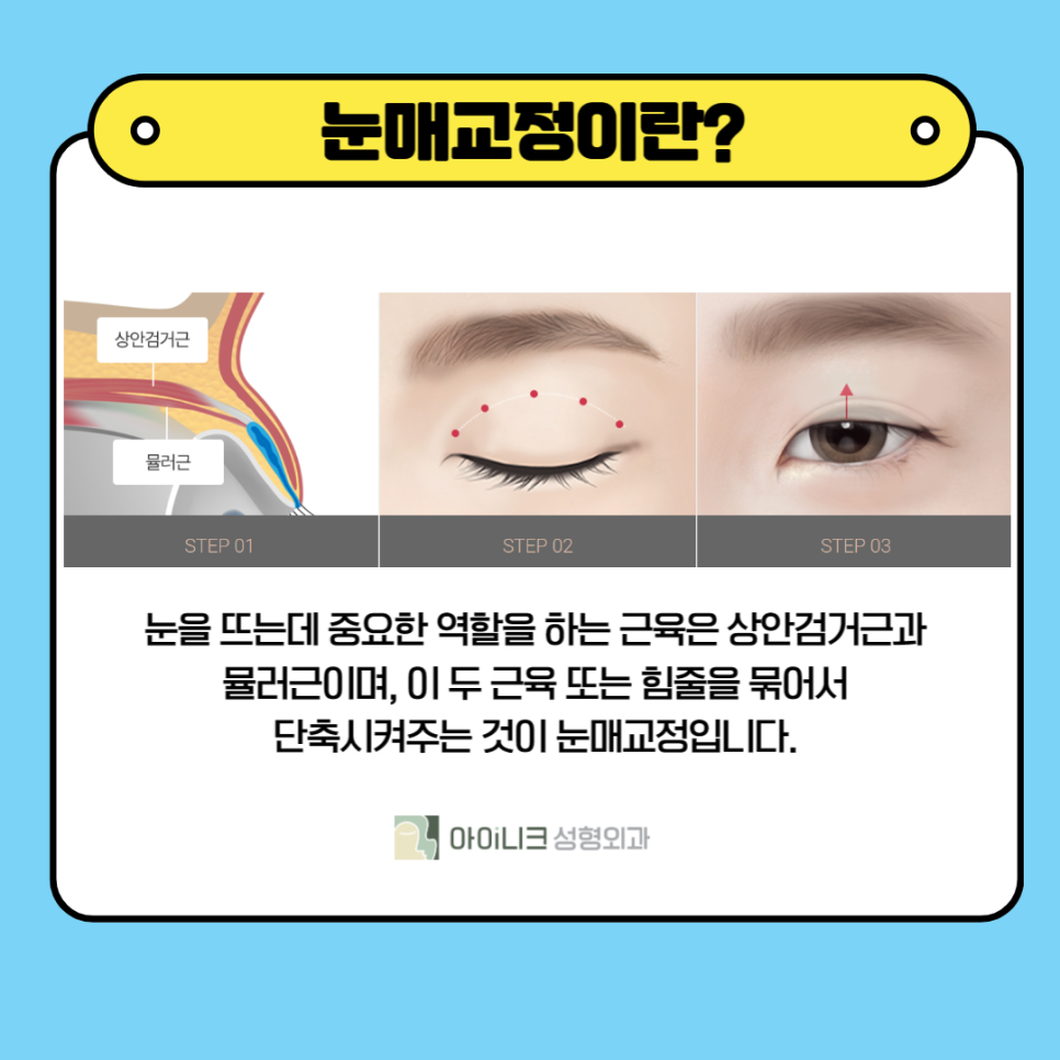 눈매교정잘하는곳에서 졸린 눈 해결 후기 관련 이미지 4