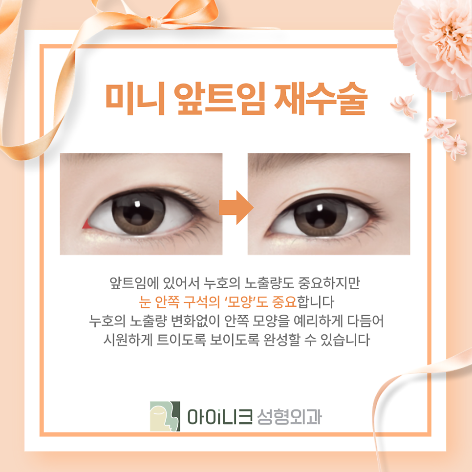 눈재수술잘하는곳 과도한 앞트임 재건이 문제라면 관련 이미지 12