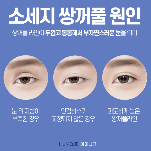 눈재수술성형외과를 알아보고 있다면 첫 수술부다 신중해야 한다 관련 이미지 3