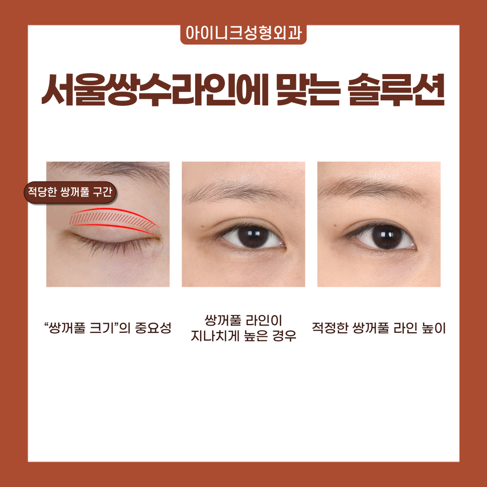 서울 쌍수 라인으로 자연스럽게! 관련 이미지 4