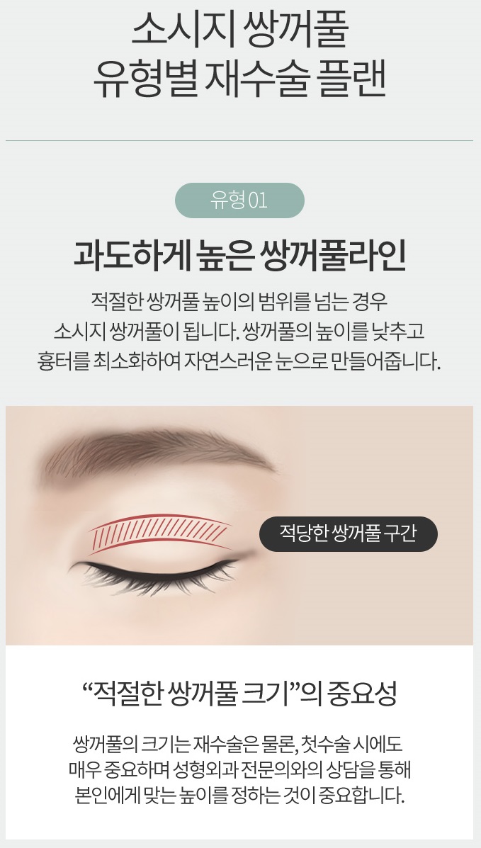 소시지쌍꺼풀 원인부터 파악하자! 관련 이미지 3