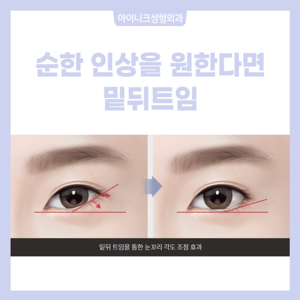 눈트임수술종류 다양하게 알아보고 선택하자! 관련 이미지 5