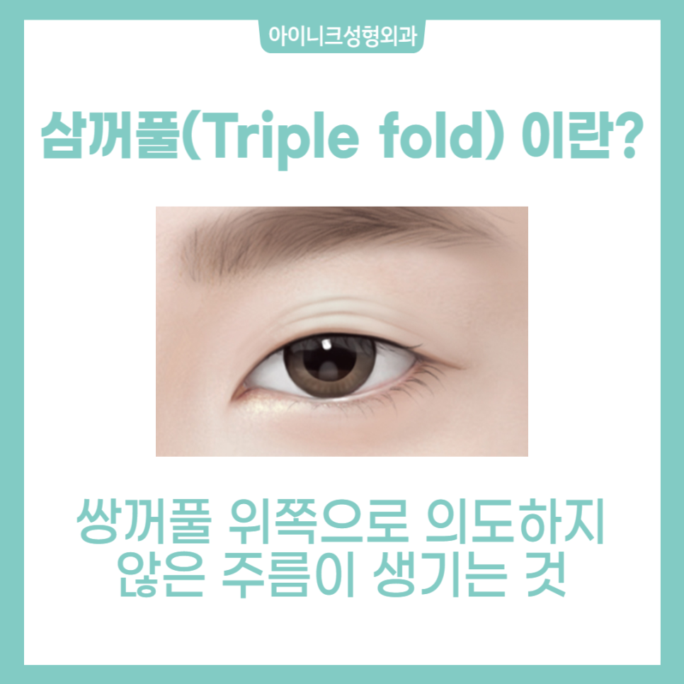 쌍꺼풀 여러겹 해결할 수 있을까? 관련 이미지 2