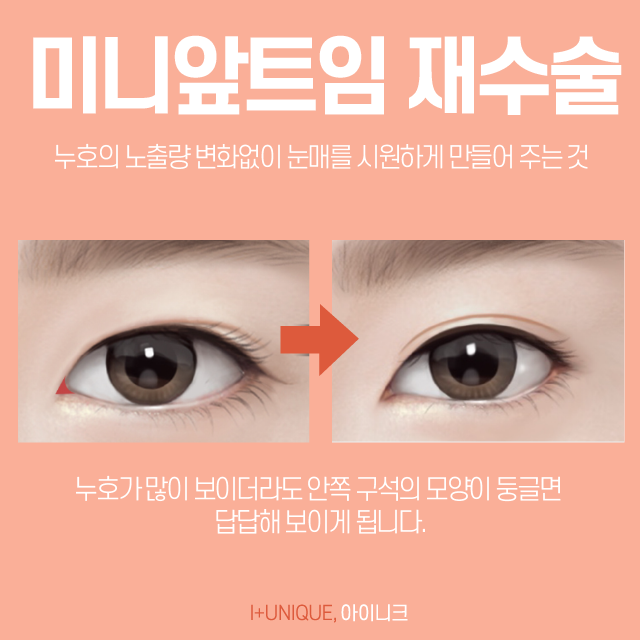 과교정이 된 눈, 수술을 해도 어딘가 답답한 눈은 앞트임복원술로 해결! 관련 이미지 4