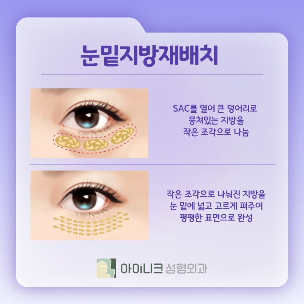 눈수술종류 내게 맞는 방법은 무엇? 관련 이미지 8