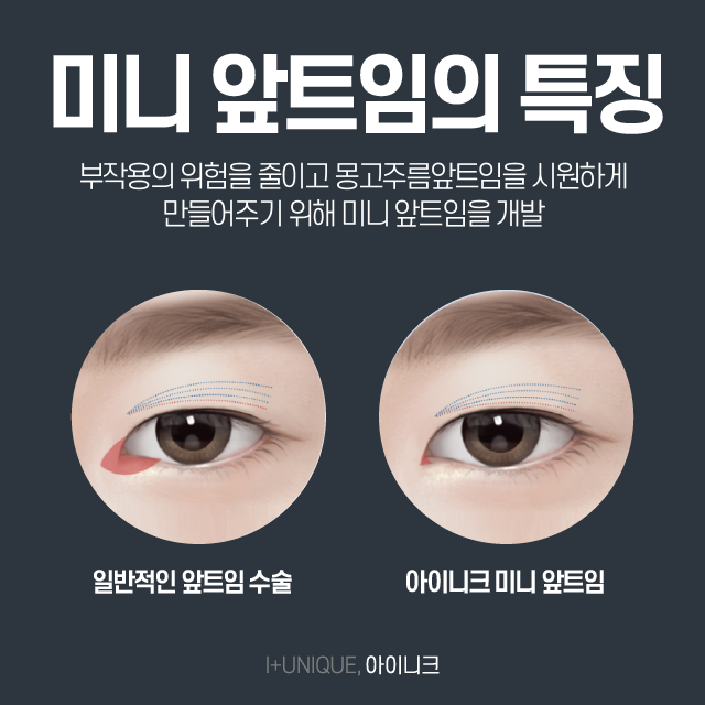 몽고주름앞트임 여기로 결정하자. 관련 이미지 4