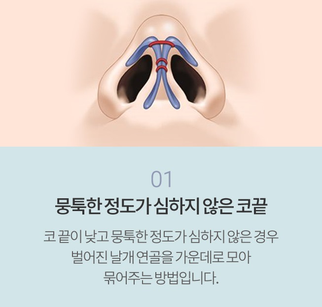 비개방코끝성형으로 처음부터 예뻤던 것처럼 관련 이미지 3