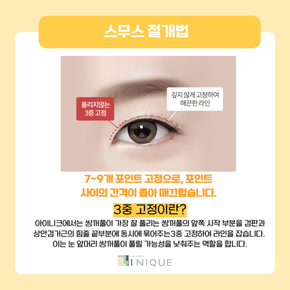 The Best Place for Double Eyelid Surgery for Women Is Right Here! image 5