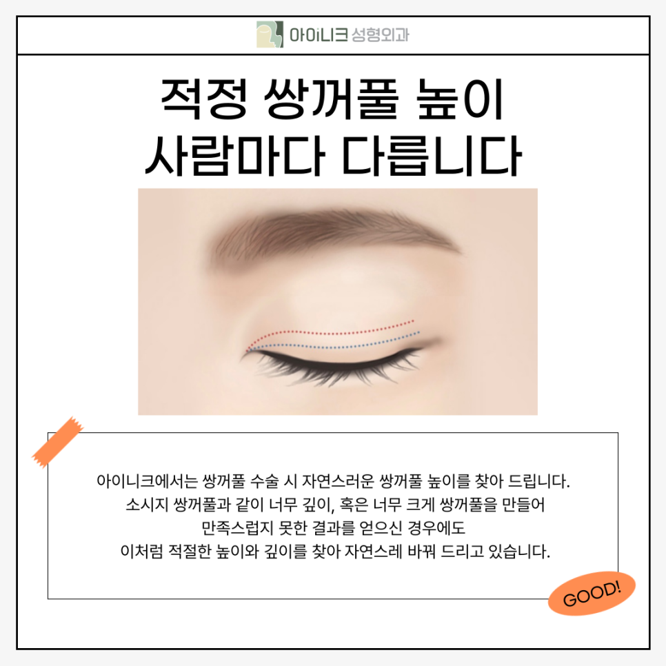 압구정눈수술 고민이라면 관련 이미지 3
