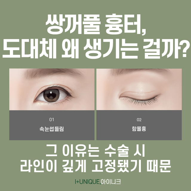 쌍꺼풀수술 흉터, 아이니크가 책임질게! 관련 이미지 2