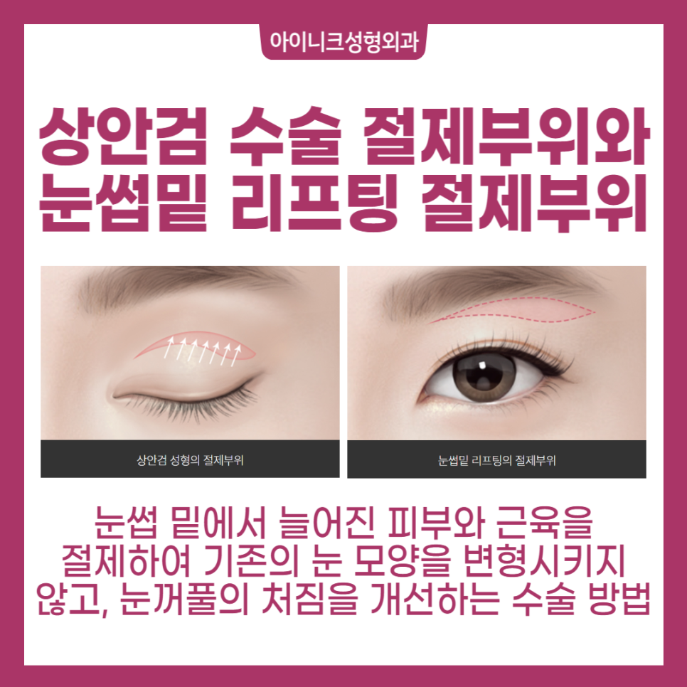 Lower Blepharoplasty for the Under-Eye Area, Safe and Successful image 3