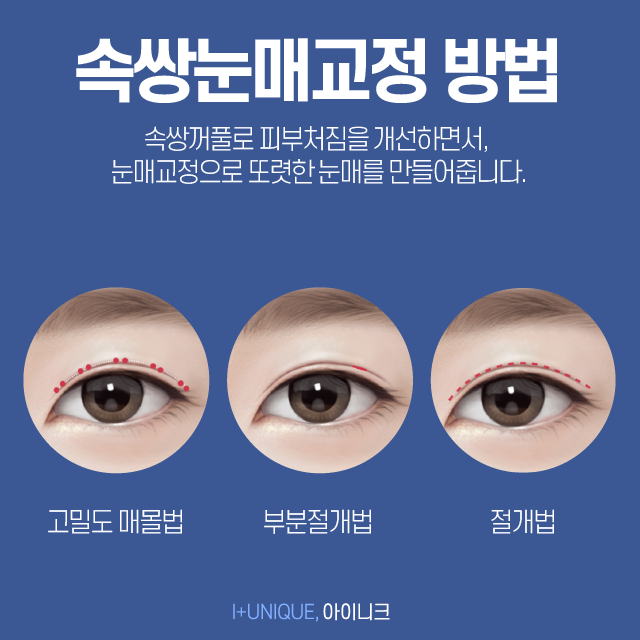 남자쌍커풀수술도 얼마나 자연스럽냐가 관건! 관련 이미지 3