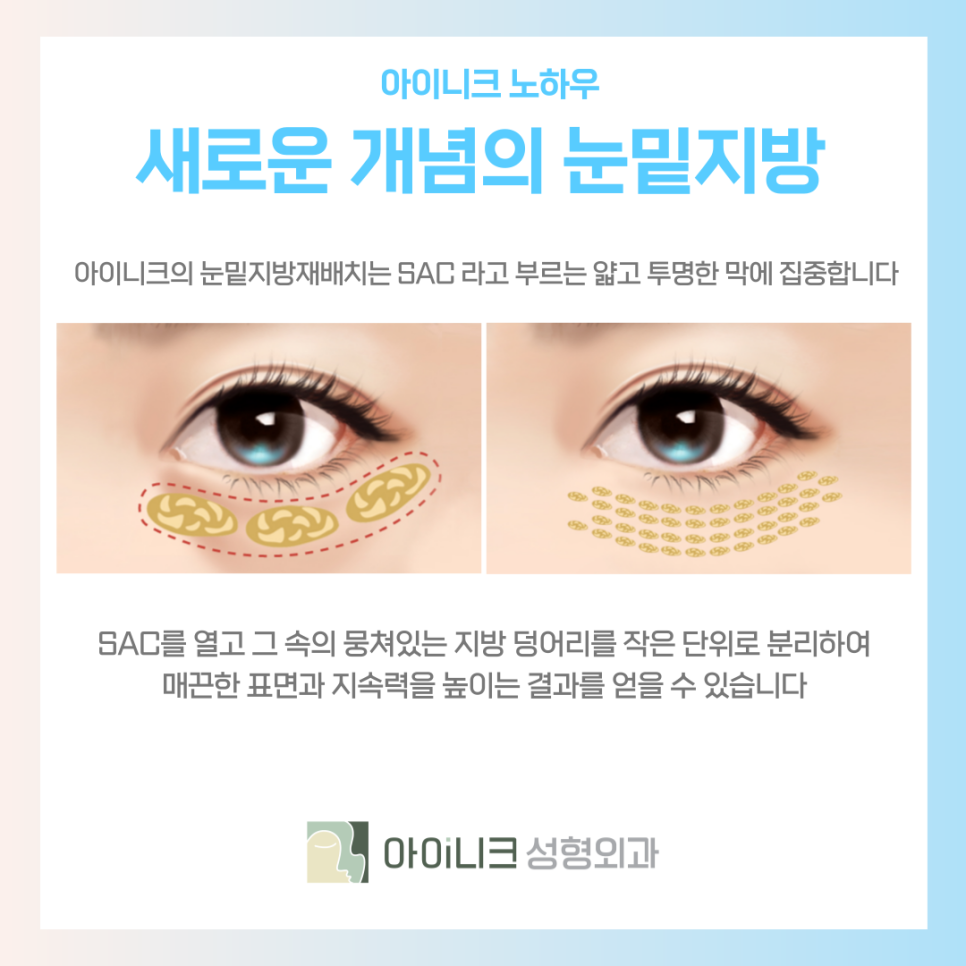 눈지방재배치 새로운 방식으로 동안 페이스 되기 관련 이미지 7