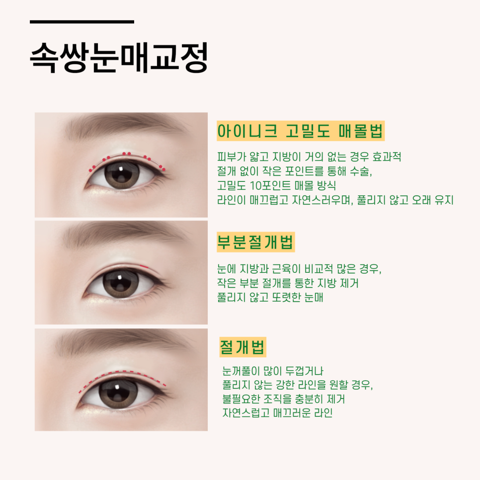 남자속쌍눈매교정 성공하는 법 관련 이미지 3