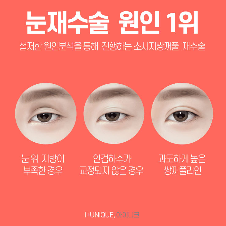성형외과재수술은 보다 신중하게 결정하자 아이니크성형외과에서 관련 이미지 2