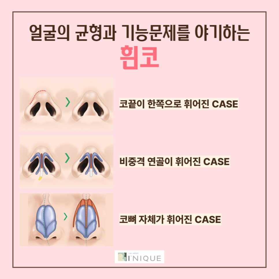 여자코수술, 나에게 맞는 디자인으로! 관련 이미지 3