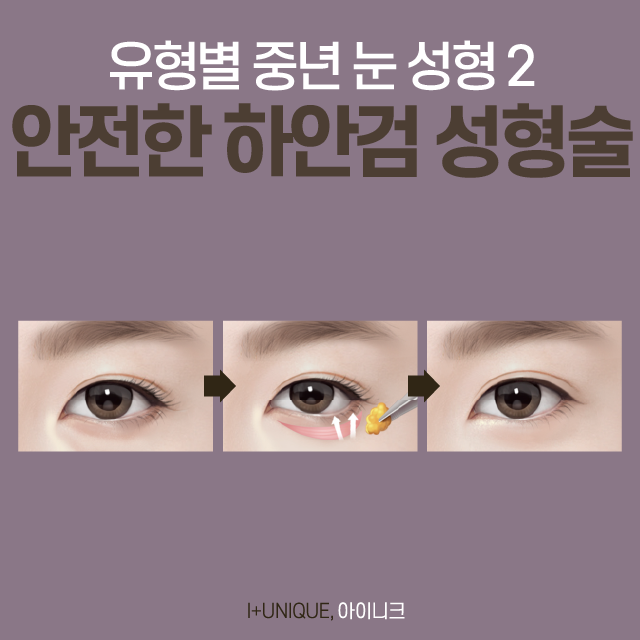 중년 눈 성형? 쌍꺼풀보다 눈썹 밑 리프팅, 하안검 수술 추천 관련 이미지 5