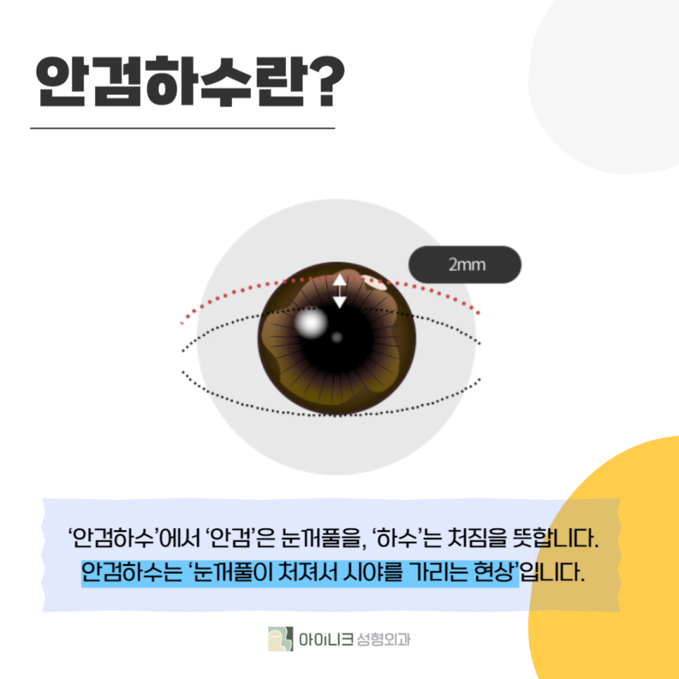 처진눈꺼풀개선이 필요하다면 주목! 관련 이미지 2