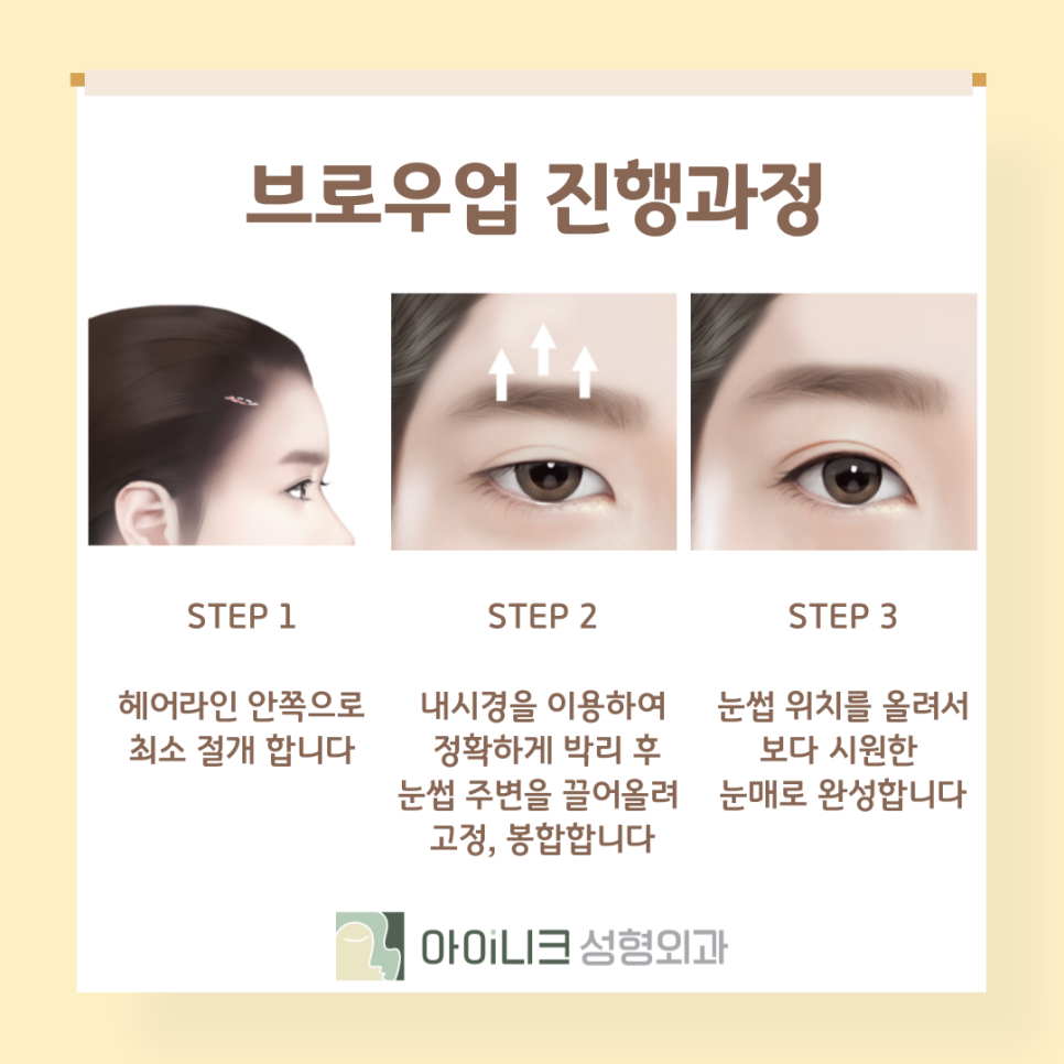 눈썹을 올려 인상을 개선? 브로우업 관련 이미지 6