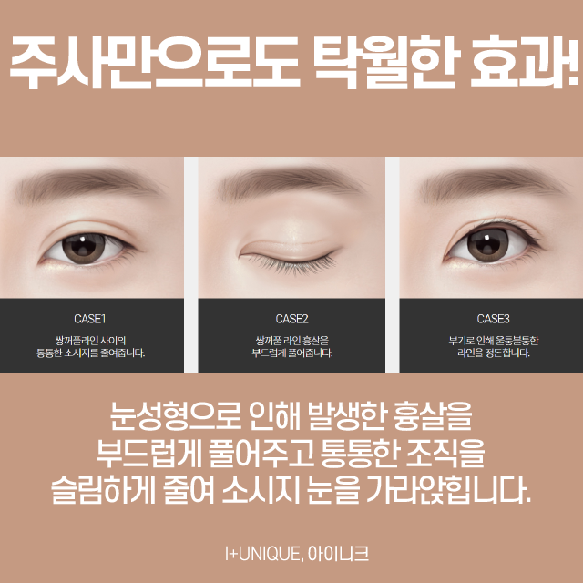 소시지눈주사추천, 눈 성형 전문병원에서! 관련 이미지 5
