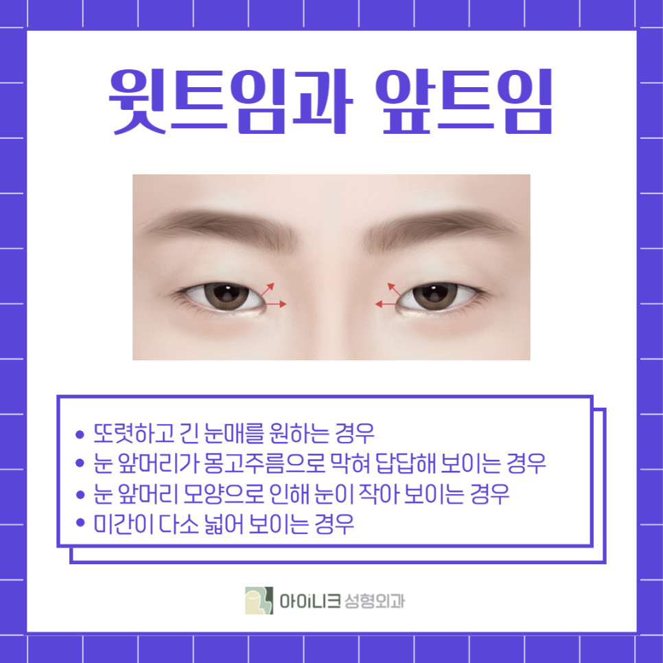 Upper Epicanthoplasty Effects: Significantly Improve a Heavy-Looking Eye Shape! image 3