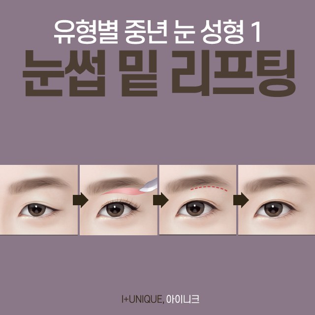 중년 눈 성형? 쌍꺼풀보다 눈썹 밑 리프팅, 하안검 수술 추천 관련 이미지 4