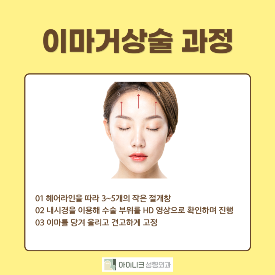 눈썹거상술로 티나지 않고 또렷한 인상으로! 관련 이미지 3