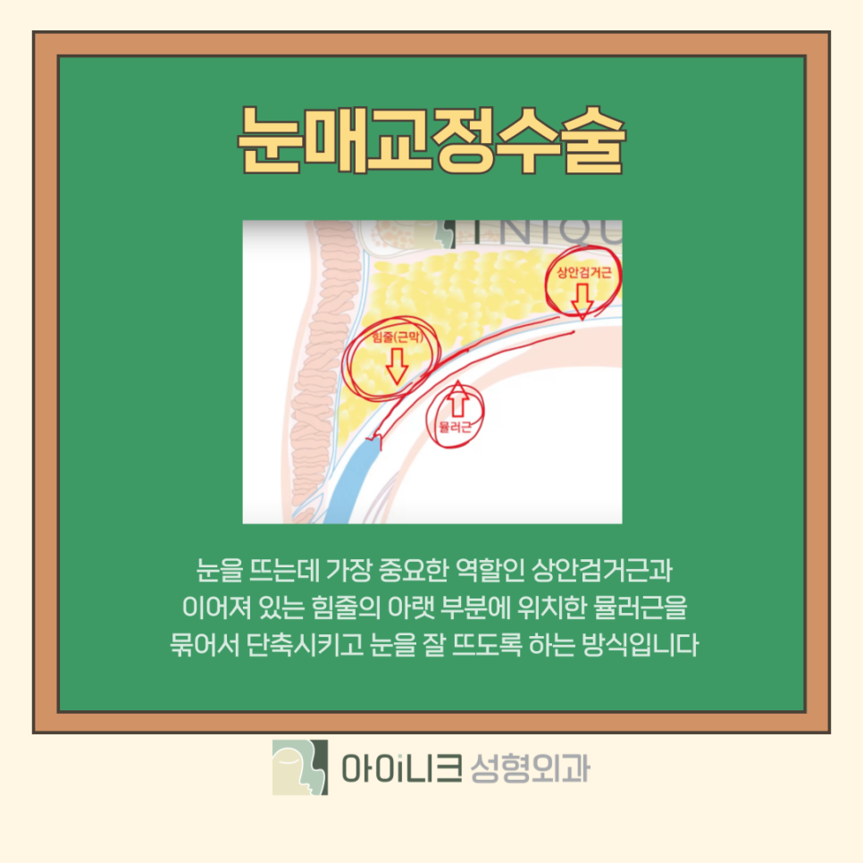 눈매교정수술로 눈 뜨는 힘 키워주기 관련 이미지 8