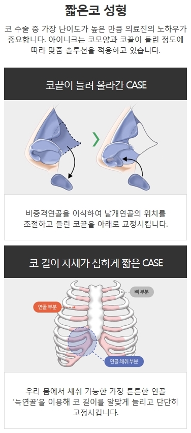 늑연골코성형 코재수술 잘하는 곳 관련 이미지 3