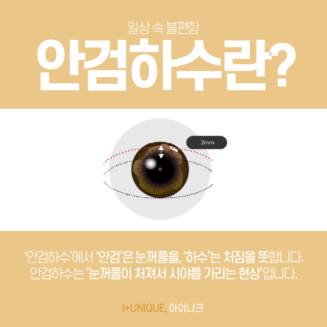 눈매교정수술, 당신이 안검하수라면 비절개눈매교정에 주목하세요. 관련 이미지 2