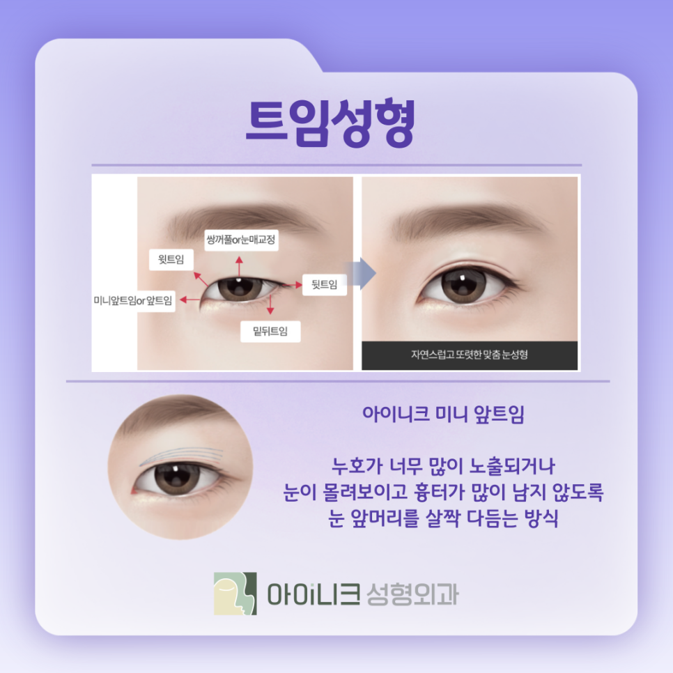 눈수술종류 내게 맞는 방법은 무엇? 관련 이미지 7