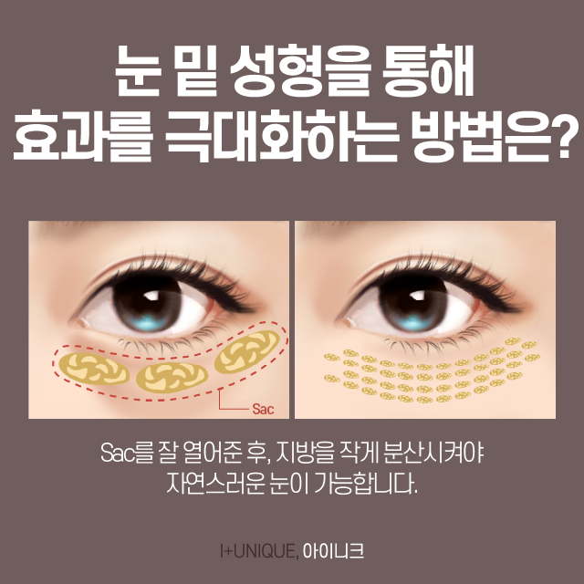 눈밑성형 확 달라지는 인상 관련 이미지 4