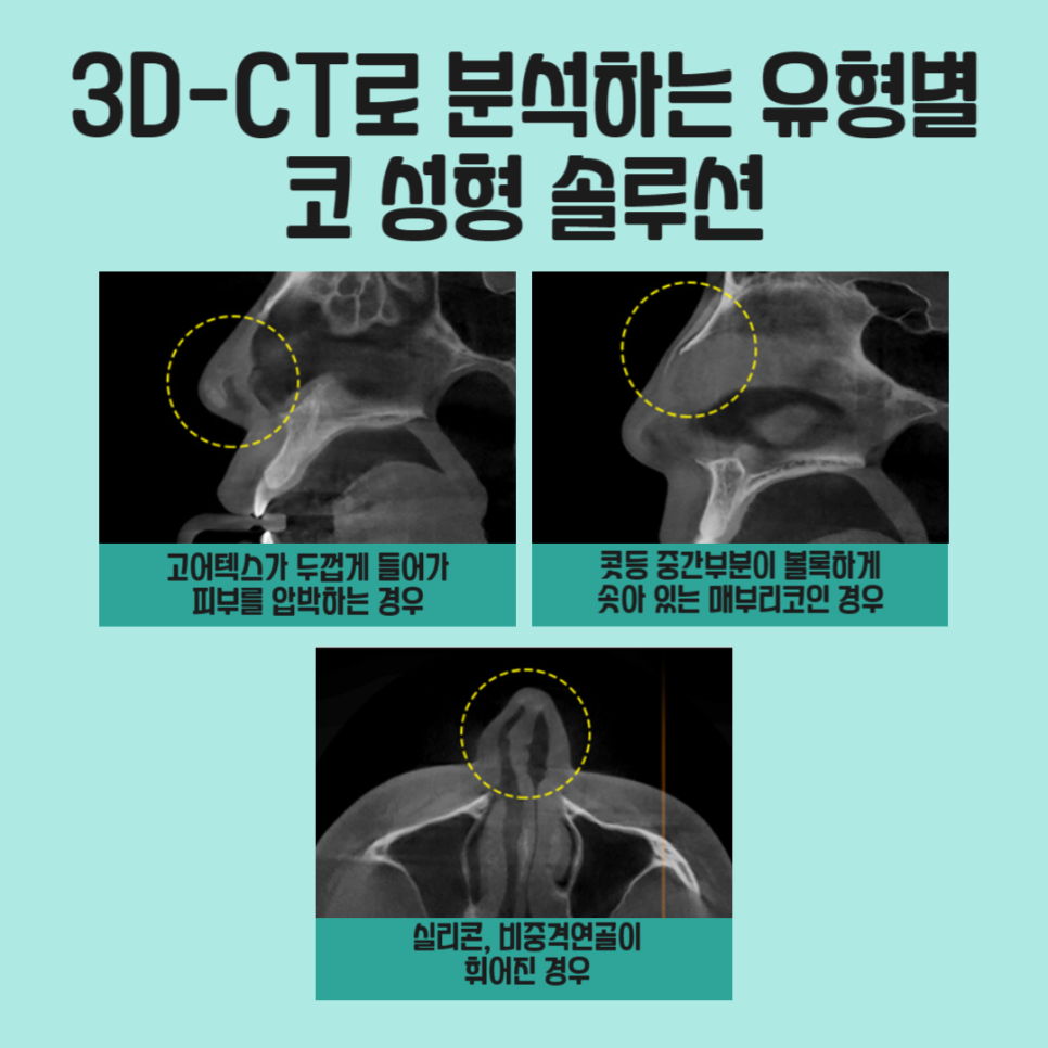 코성형붓기 걱정없는 아이니크의 코성형 관련 이미지 3