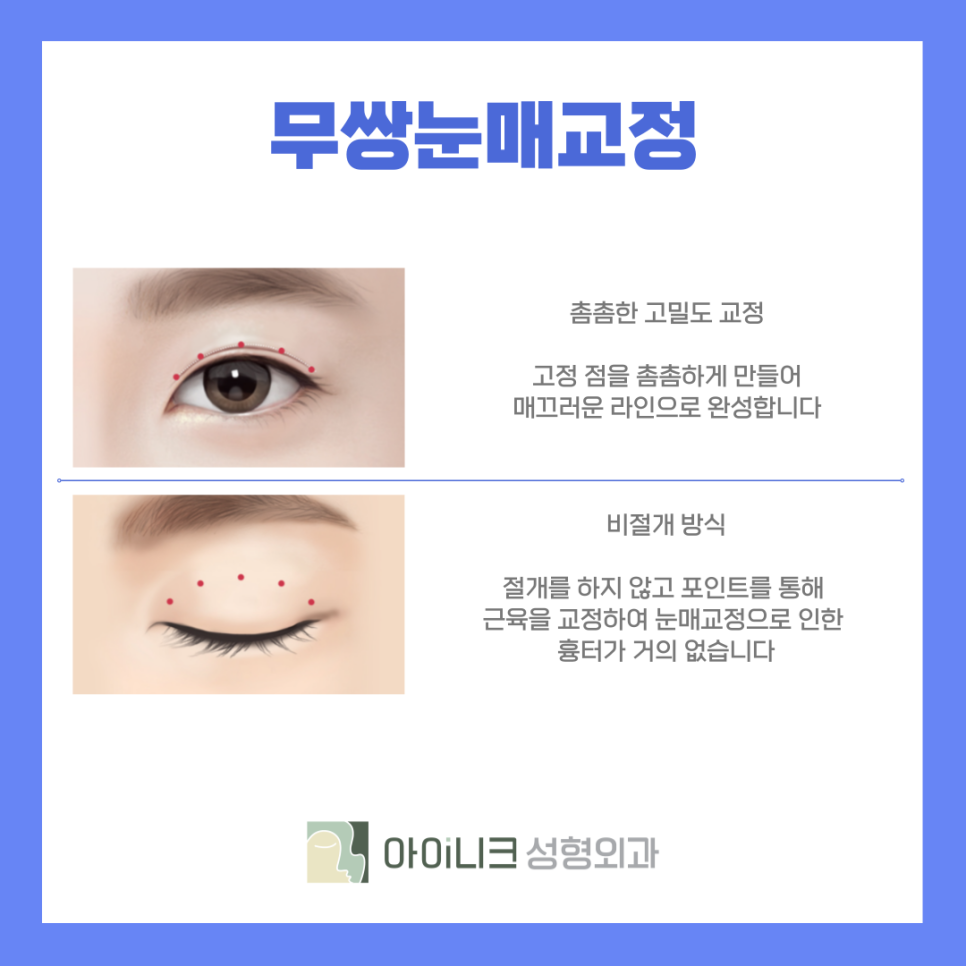 강남 남자 자연스러운 쌍수 또렷하고 티나지 않게 관련 이미지 7
